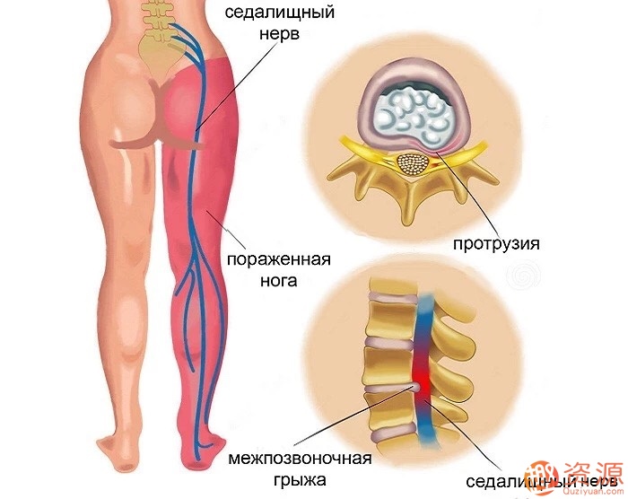 腰椎間盤突出康復訓練插圖2